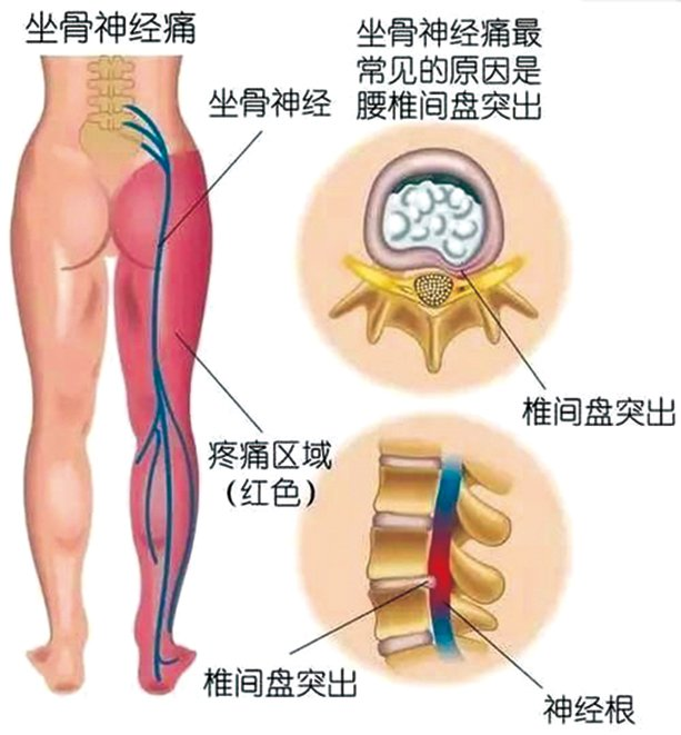 关于腰椎间盘突出的3个“谣言”