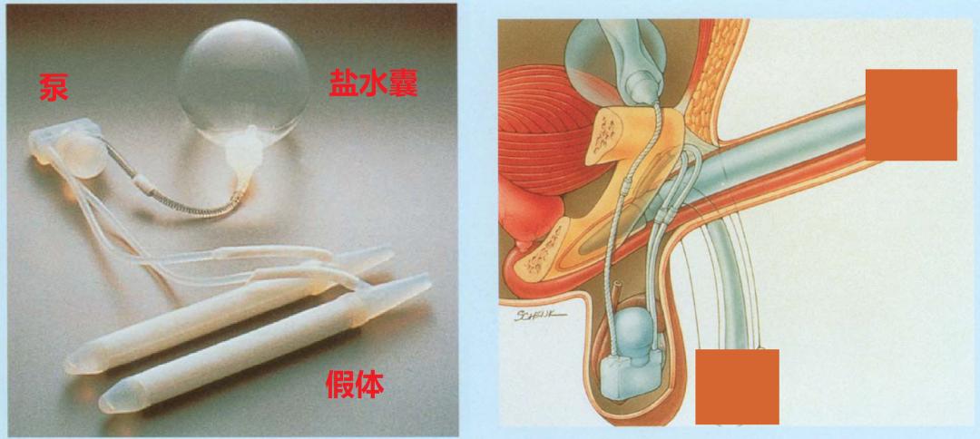 伟哥问世前，人们什么办法都试过了