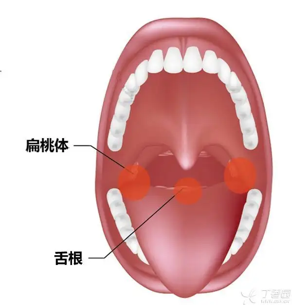 被鱼刺卡住喉咙怎么办?